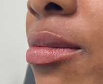 client after juvederm lip fillers in atlanta