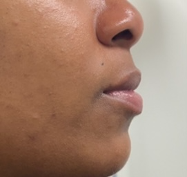 client before juvederm lip fillers in atlanta