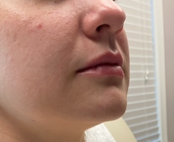 client before juvederm lip fillers in atlanta